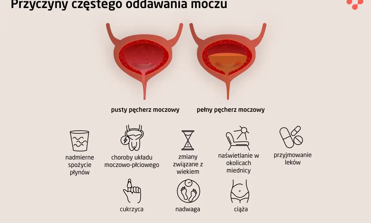 Ilustracja pokazuje pusty i pełny pęcherz moczowy, wyjaśniając przyczyny częstego oddawania moczu, w tym uczucie pełnego pęcherza.