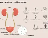 Objawy niebakteryjnego zapalenia cewki moczowej: świąd, ból, pieczenie, częste oddawanie moczu, gorączka, powiększone węzły chłonne.