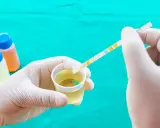 Rękawiczka medyczna zanurza pasek testowy w próbce moczu, szukając oznak cienkich nitek.
