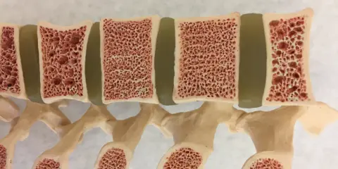 Model kręgosłupa z widocznymi przekrojami kości, ukazujący ich gąbczastą strukturę. Może to być przykład osteoporozy w młodym wieku.