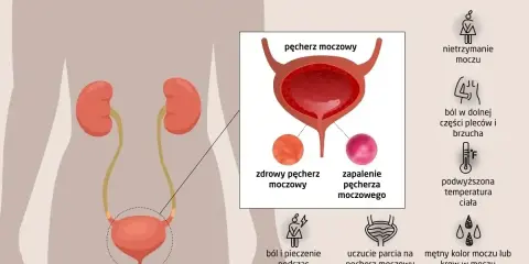 Ból i pieczenie przy oddawaniu moczu to objawy zapalenia pęcherza. Ilustracja pokazuje układ moczowy i symptomy infekcji.