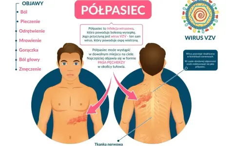 Objawy półpaśca: ból, pieczenie, odrętwienie, mrowienie, gorączka, ból głowy, zmęczenie. Jak złagodzić ból przy półpaścu? Półpasiec to wirus VZV.