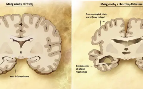 Porównanie mózgu zdrowego i z chorobą Alzheimera: widoczne zmniejszenie hipokampa i kory mózgowej, co jest kluczowe w demencji.