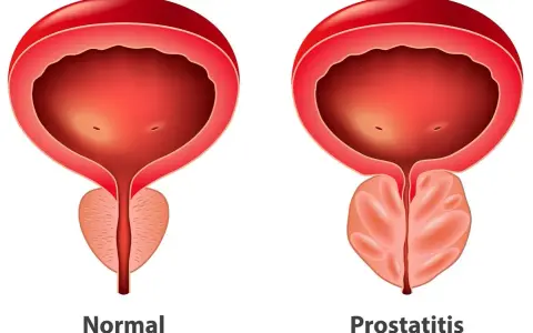 Porównanie: prawidłowa prostata i przerost gruczołu krokowego. Widoczny powiększony gruczoł krokowy uciska cewkę moczową.