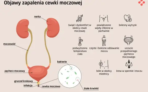 Objawy niebakteryjnego zapalenia cewki moczowej: świąd, ból, pieczenie, częste oddawanie moczu, gorączka, powiększone węzły chłonne.