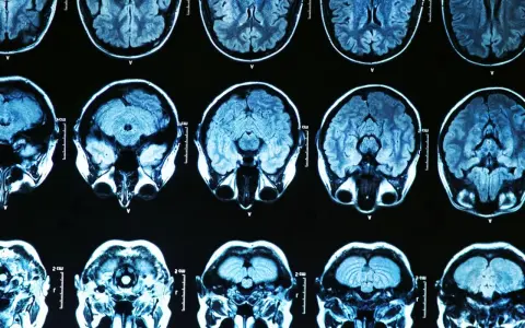 Przekroje mózgu na rezonansie magnetycznym. Badanie może pomóc w diagnostyce choroba parkinsona przyczyny.