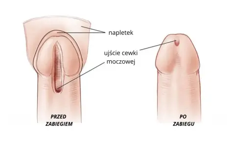 Przed zabiegiem widoczne zwężenie cewki moczowej, po zabiegu ujście cewki moczowej jest prawidłowe.