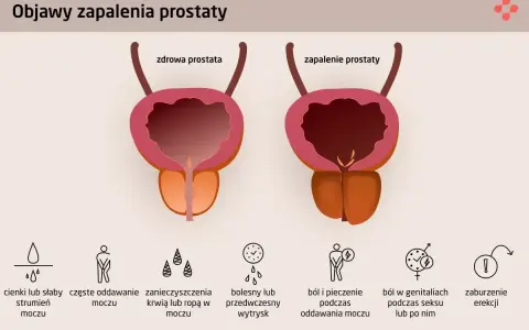 Objawy zapalenia prostaty: stercz zdrowy i chory, problemy z oddawaniem moczu, ból, zaburzenia erekcji.