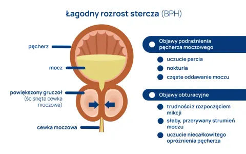 Ilustracja przedstawia łagodny rozrost stercza (BPH), gdzie powiększony gruczoł uciska cewkę moczową, powodując objawy takie jak trudności z oddawaniem moczu. To może być powód, gdzie boli prostata.