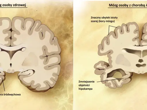 Porównanie mózgu zdrowego i z chorobą Alzheimera: widoczne zmniejszenie hipokampa i kory mózgowej, co jest kluczowe w demencji.