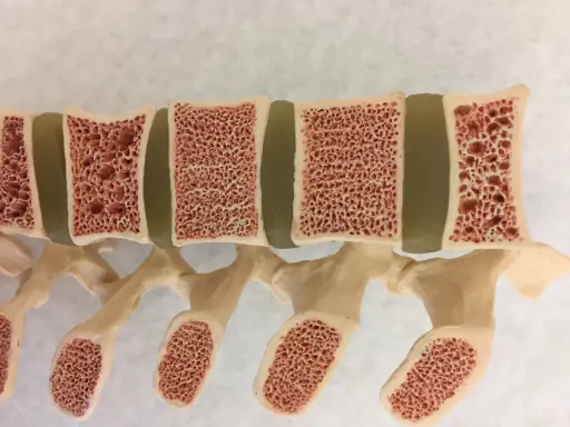 Model kręgosłupa z widocznymi przekrojami kości, ukazujący ich gąbczastą strukturę. Może to być przykład osteoporozy w młodym wieku.