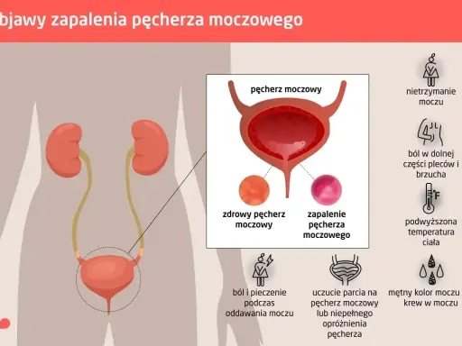 Ból i pieczenie przy oddawaniu moczu to objawy zapalenia pęcherza. Ilustracja pokazuje układ moczowy i symptomy infekcji.
