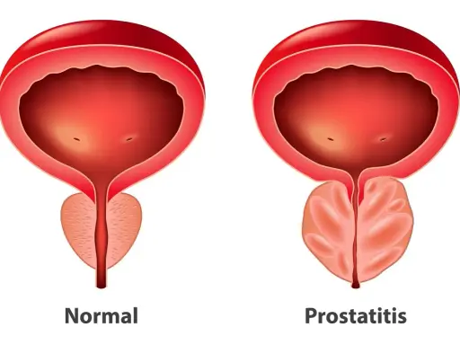 Porównanie: prawidłowa prostata i przerost gruczołu krokowego. Widoczny powiększony gruczoł krokowy uciska cewkę moczową.