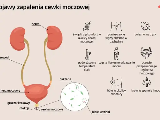 Objawy niebakteryjnego zapalenia cewki moczowej: świąd, ból, pieczenie, częste oddawanie moczu, gorączka, powiększone węzły chłonne.