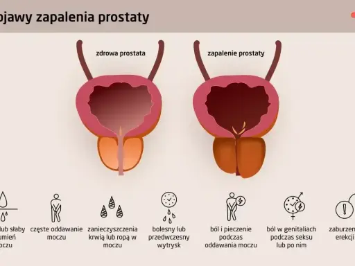 Ilustracja porównuje zdrową prostatę z zapaloną, pokazując objawy zapalenia prostaty: ból, pieczenie, zaburzenia erekcji i problemy z oddawaniem moczu.