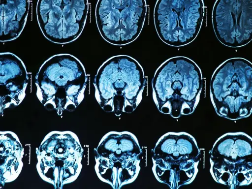 Przekroje mózgu na rezonansie magnetycznym. Badanie może pomóc w diagnostyce choroba parkinsona przyczyny.