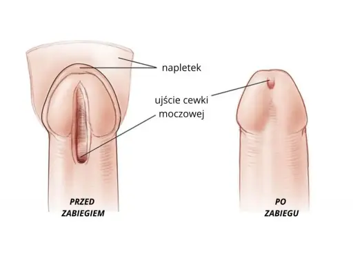 Przed zabiegiem widoczne zwężenie cewki moczowej, po zabiegu ujście cewki moczowej jest prawidłowe.
