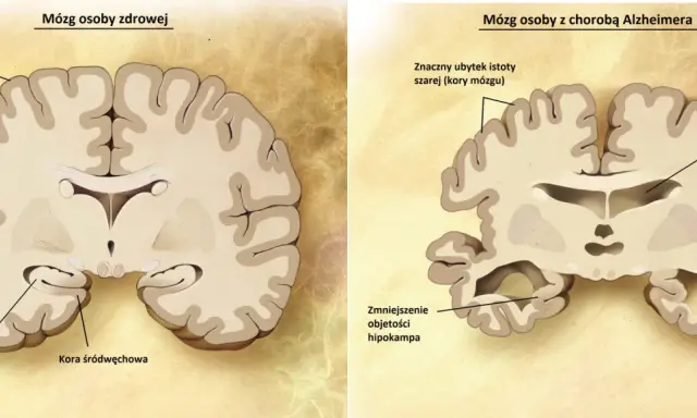 Porównanie mózgu zdrowego i z chorobą Alzheimera: widoczne zmniejszenie hipokampa i kory mózgowej, co jest kluczowe w demencji.