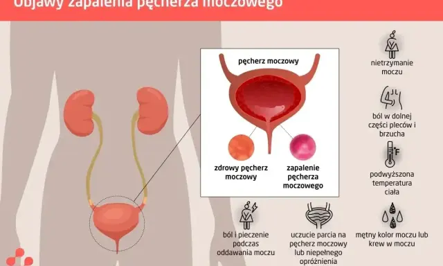 Ból i pieczenie przy oddawaniu moczu to objawy zapalenia pęcherza. Ilustracja pokazuje układ moczowy i symptomy infekcji.