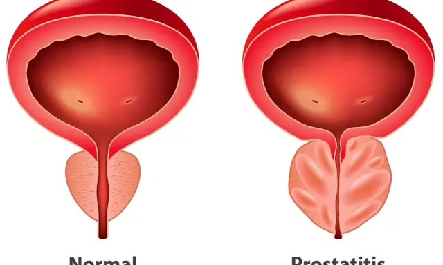 Porównanie: prawidłowa prostata i przerost gruczołu krokowego. Widoczny powiększony gruczoł krokowy uciska cewkę moczową.