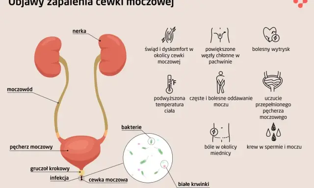 Objawy niebakteryjnego zapalenia cewki moczowej: świąd, ból, pieczenie, częste oddawanie moczu, gorączka, powiększone węzły chłonne.