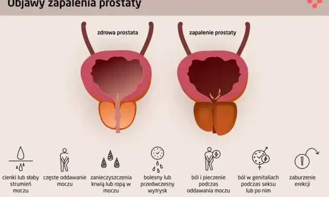 Ilustracja porównuje zdrową prostatę z zapaloną, pokazując objawy zapalenia prostaty: ból, pieczenie, zaburzenia erekcji i problemy z oddawaniem moczu.