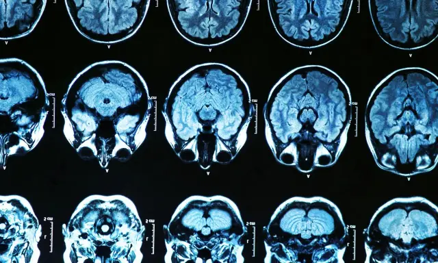 Przekroje mózgu na rezonansie magnetycznym. Badanie może pomóc w diagnostyce choroba parkinsona przyczyny.