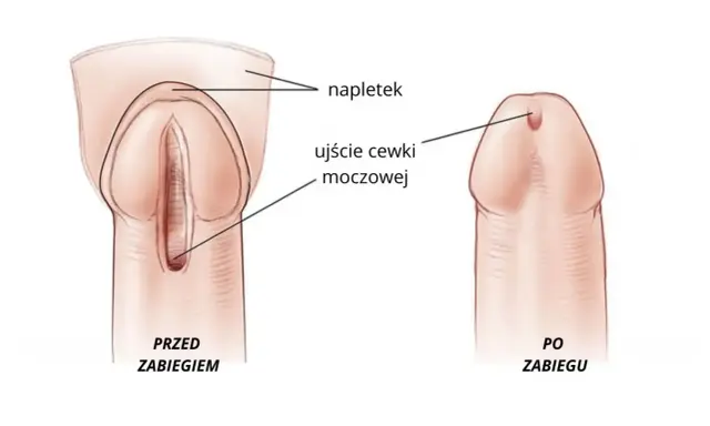 Przed zabiegiem widoczne zwężenie cewki moczowej, po zabiegu ujście cewki moczowej jest prawidłowe.