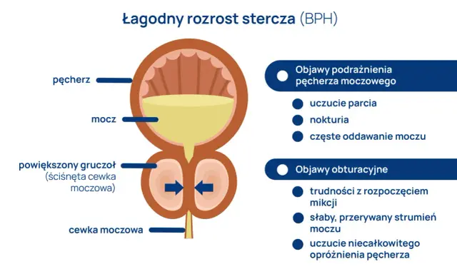 Ilustracja przedstawia łagodny rozrost stercza (BPH), gdzie powiększony gruczoł uciska cewkę moczową, powodując objawy takie jak trudności z oddawaniem moczu. To może być powód, gdzie boli prostata.