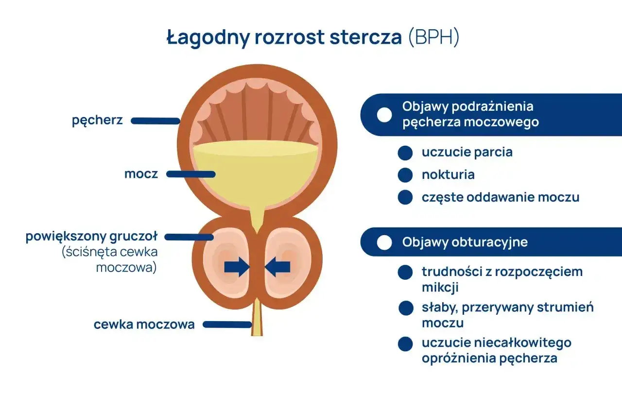 Ilustracja BPH: powiększony gruczoł uciska cewkę, powodując uczucie pełnego pęcherza, parcie i trudności z oddawaniem moczu.